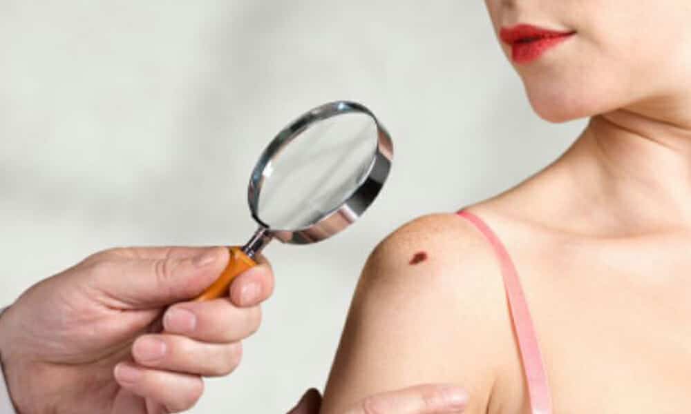 Honnan tudjuk, hogy baj van az anyajegyünkkel?