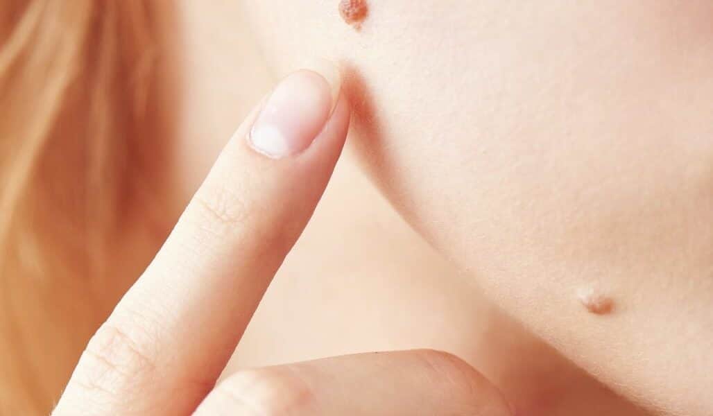 womagic_melanoma